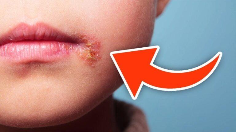 Dieser überraschende Tipp hilft dir, Herpes sicher und dauerhaft loszuwerden…